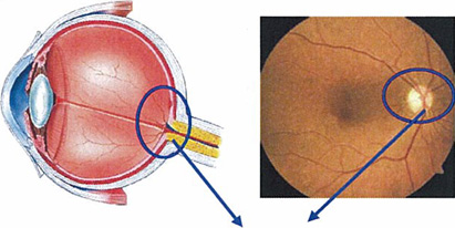 視神経乳頭周囲の視神経線維層
